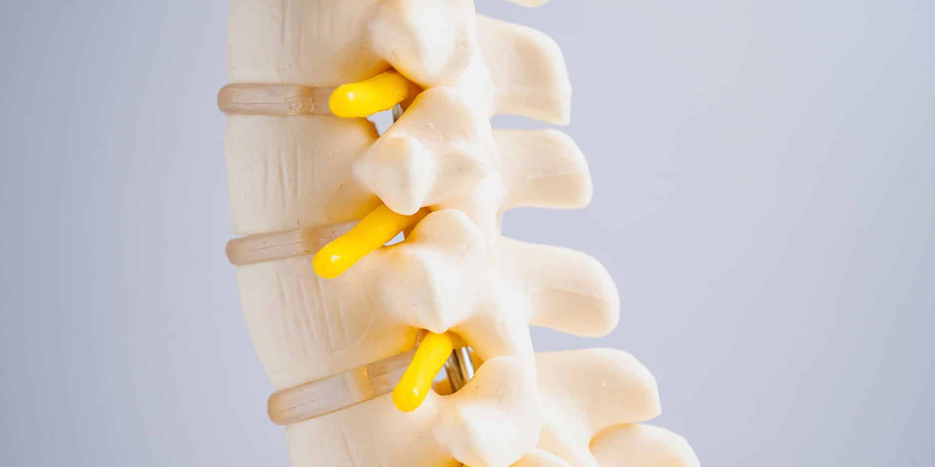 Câncer infantil e coluna: quando tumores ósseos afetam a estabilidade e o movimento